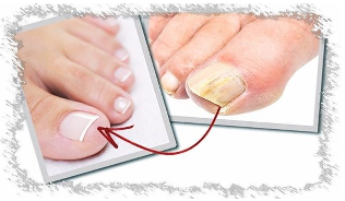 Causes the fungus of the nails