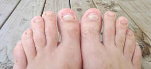 Fungus in the nails of the feet