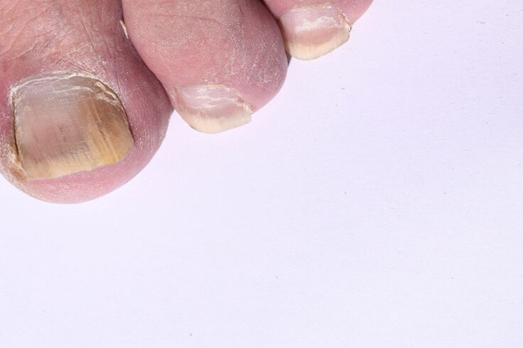 the initial stage of toenail mycosis