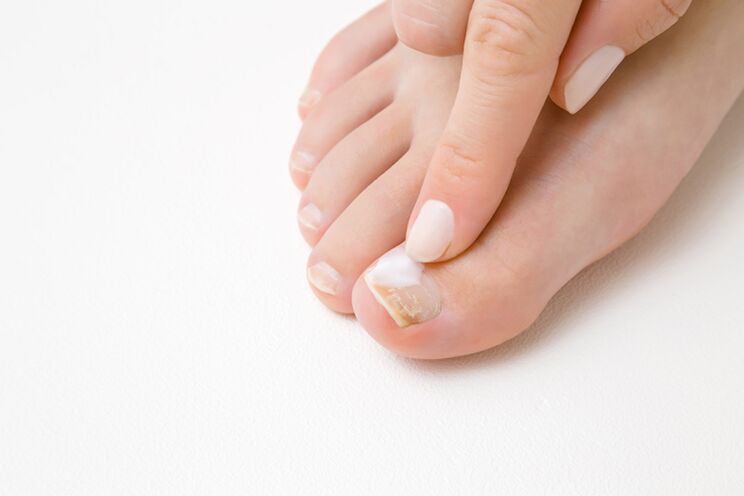 treating toes with fungus ointment