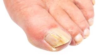what is the fungus of the nails