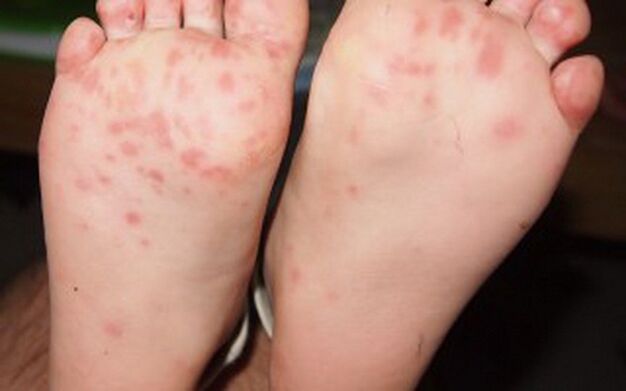 Vesicular form of fungus on the legs. 