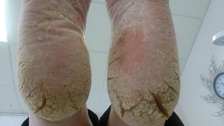 manifestations of foot fungus