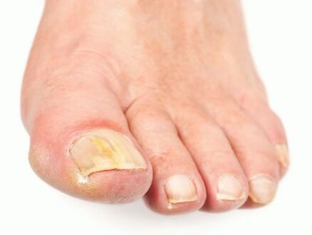 nail damage with toenail fungus