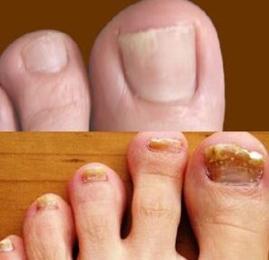 early and advanced stages of foot fungus