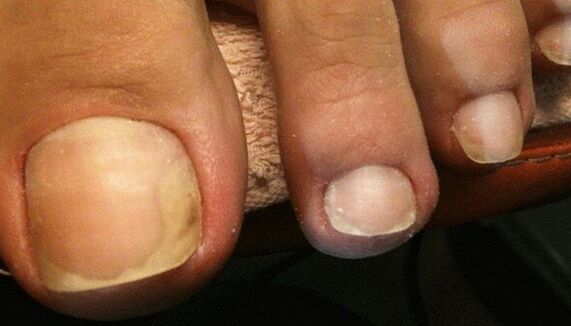Signs of the initial stage of toenail fungus. 