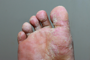 Heavy stage of mycosis of the skin of the toes
