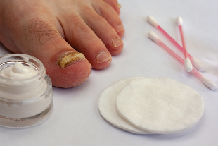 fungus in the toes